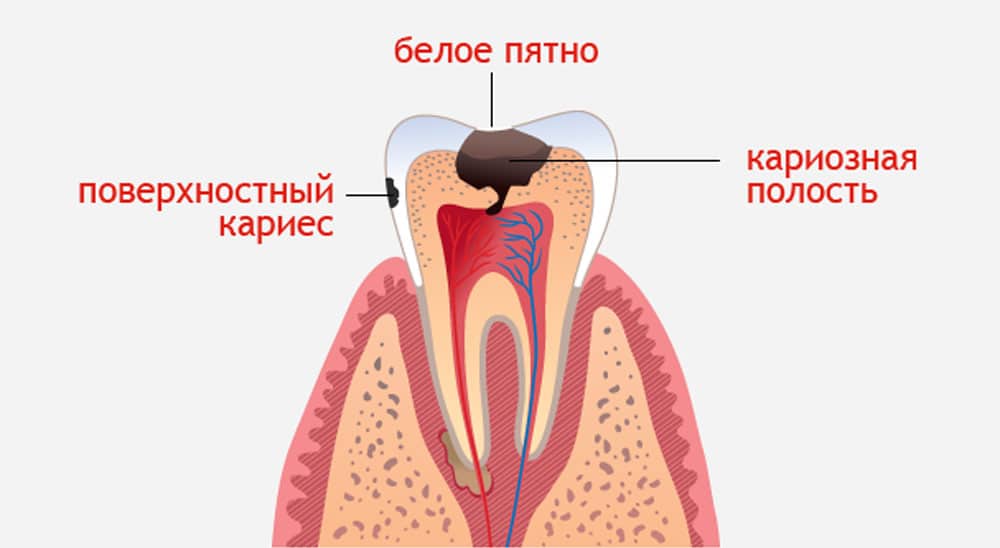 По каким причинам происходит разрушение зубов: научные исследования